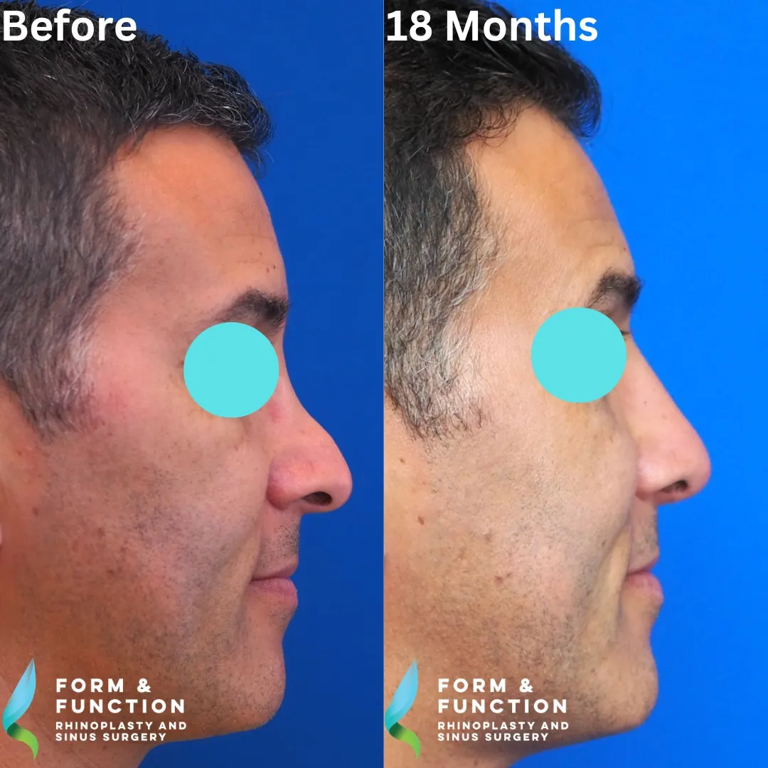 Before and after, right profile, 18 months after revision rhinoplasty with septal reconstruction