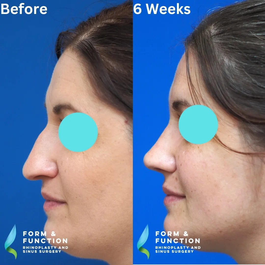 Before and after, right profile, 6 weeks after rhinoplasty and septoplasty
