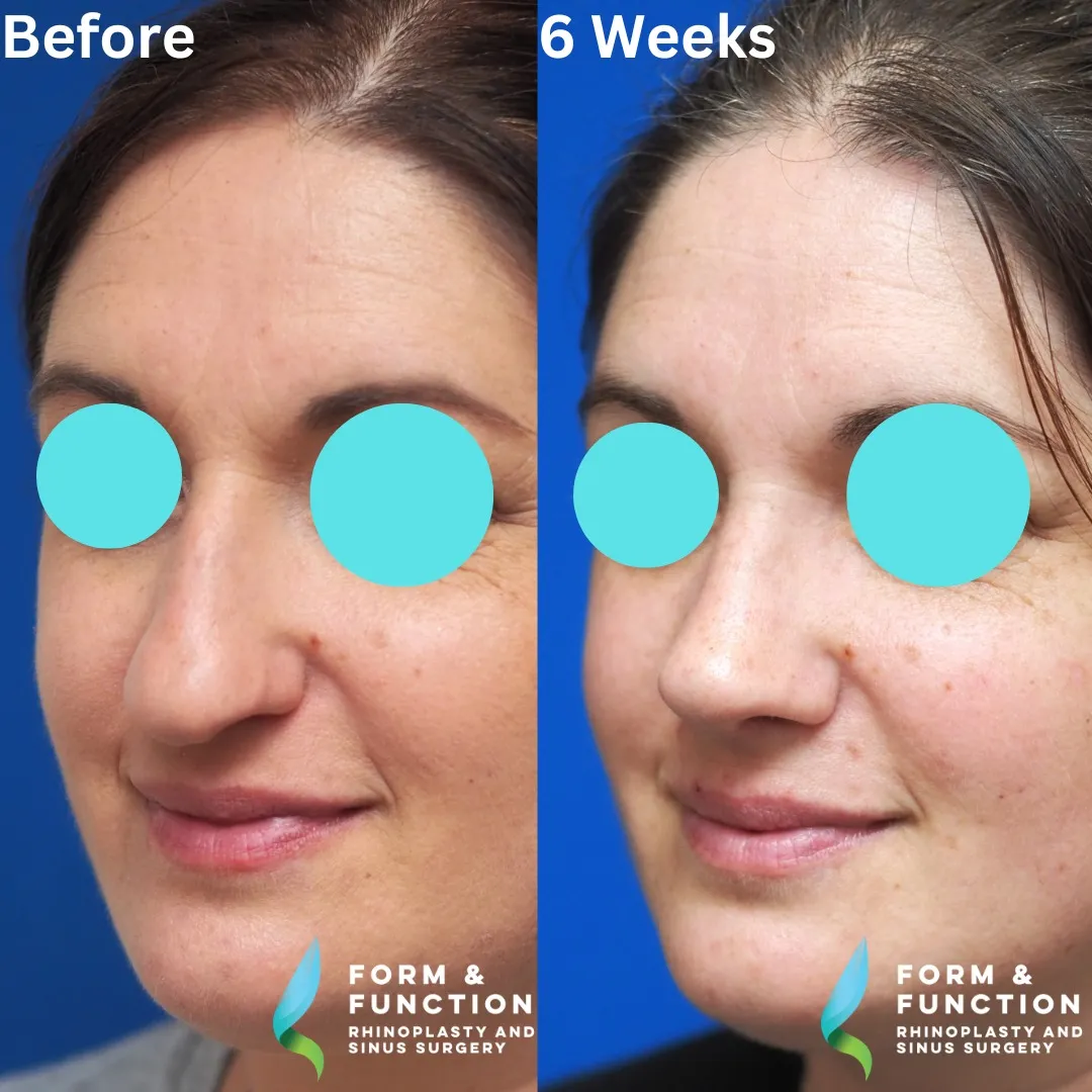 Before and after, left three-quarter view, 6 weeks after rhinoplasty and septoplasty