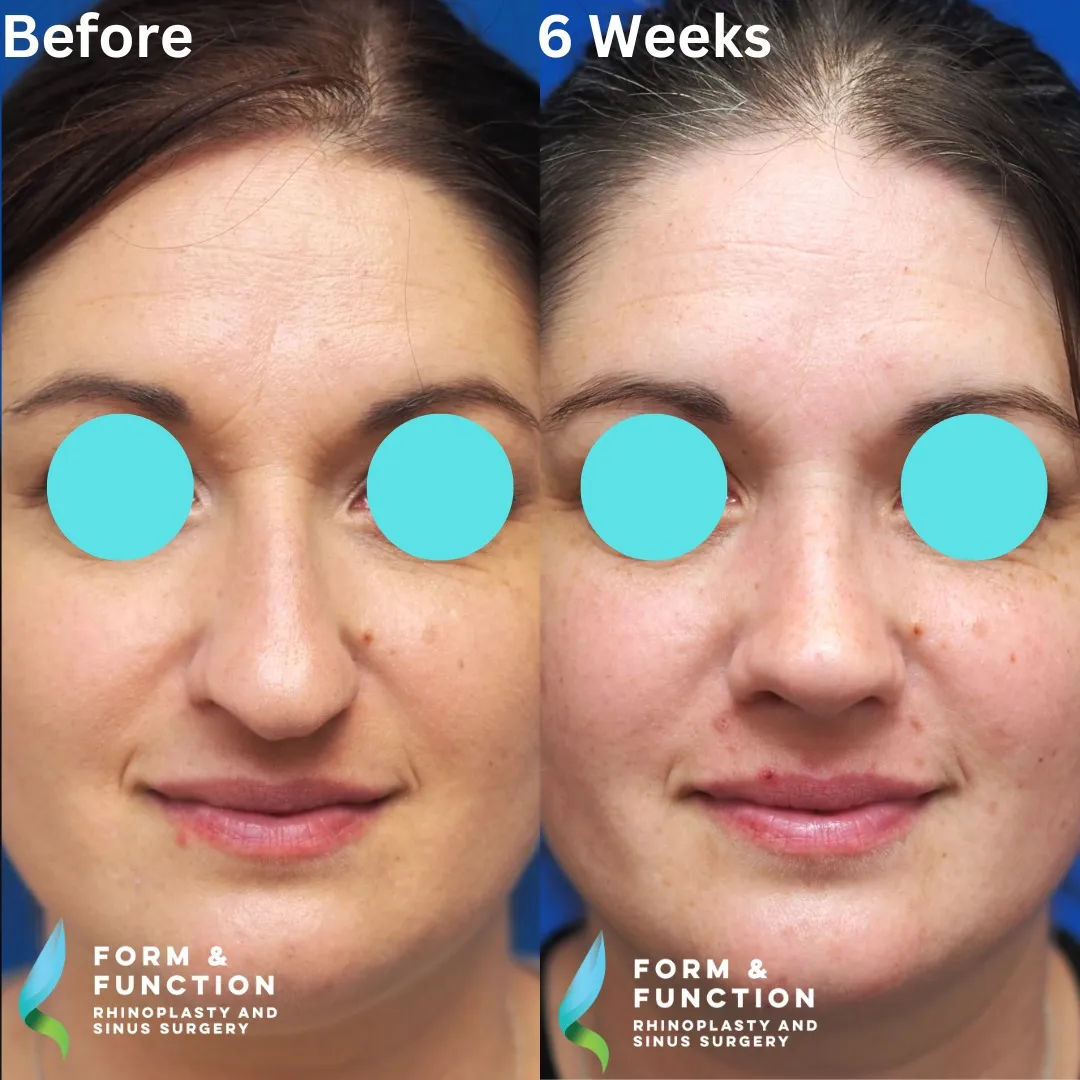 Before and after, frontal view, 6 weeks after rhinoplasty and septoplasty