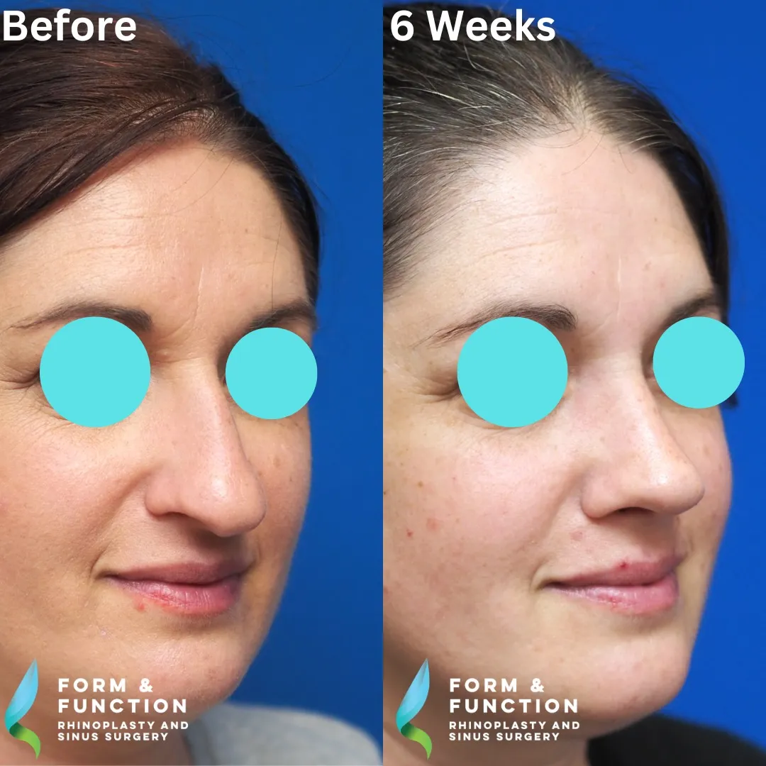 Before and after, right three-quarter view, 6 weeks after rhinoplasty and septoplasty