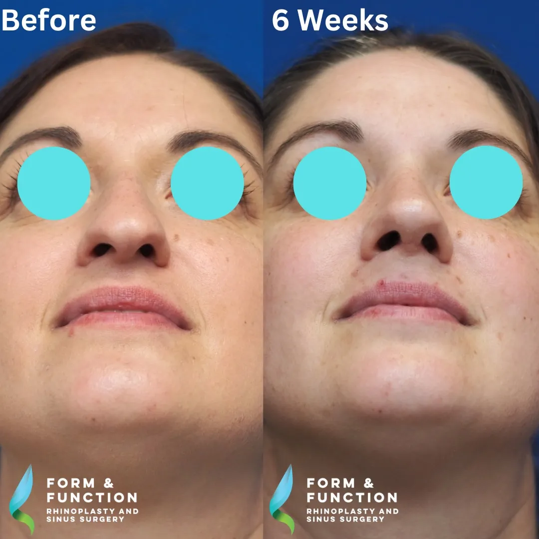 Before and after, base view, 6 weeks after rhinoplasty and septoplasty