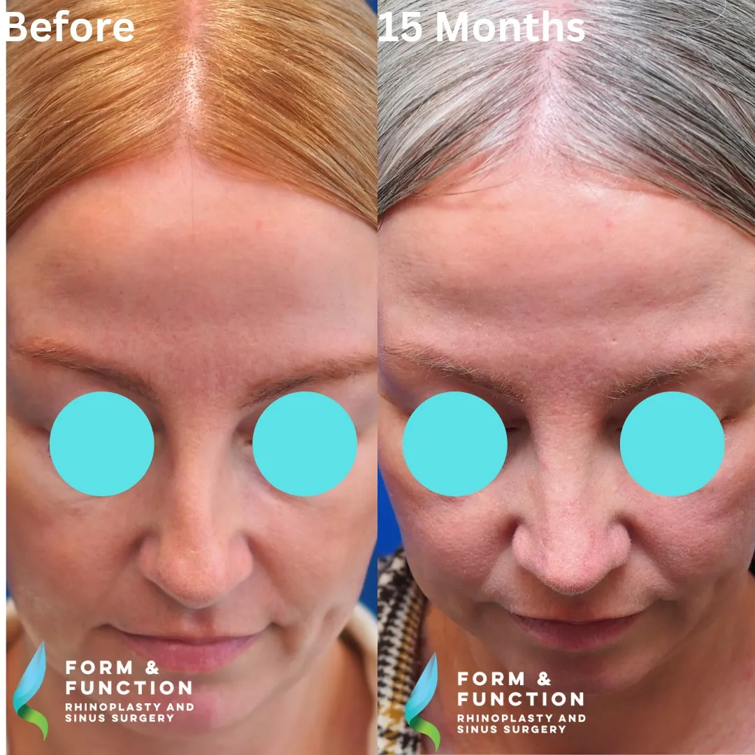 Before and after, frontal view, 15 months after rhinoplasty and septoplasty