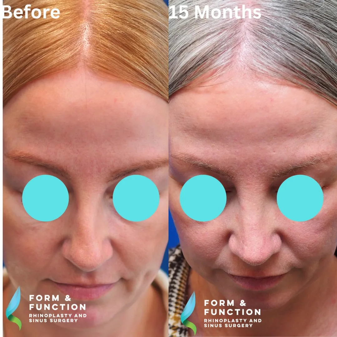 Before and after, frontal view, 15 months after rhinoplasty and septoplasty