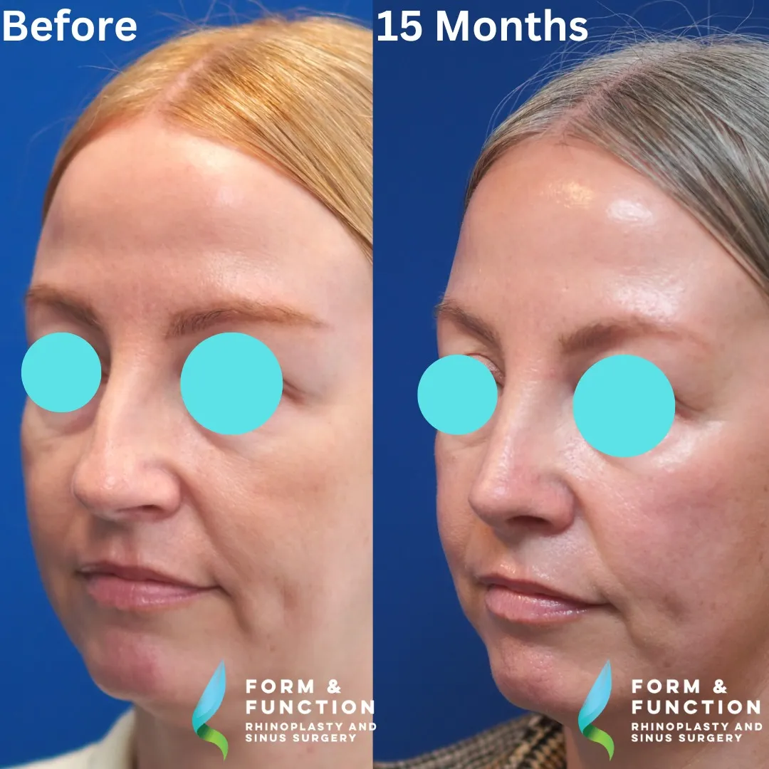 Before and after, left three-quarter view, 15 months after rhinoplasty and septoplasty