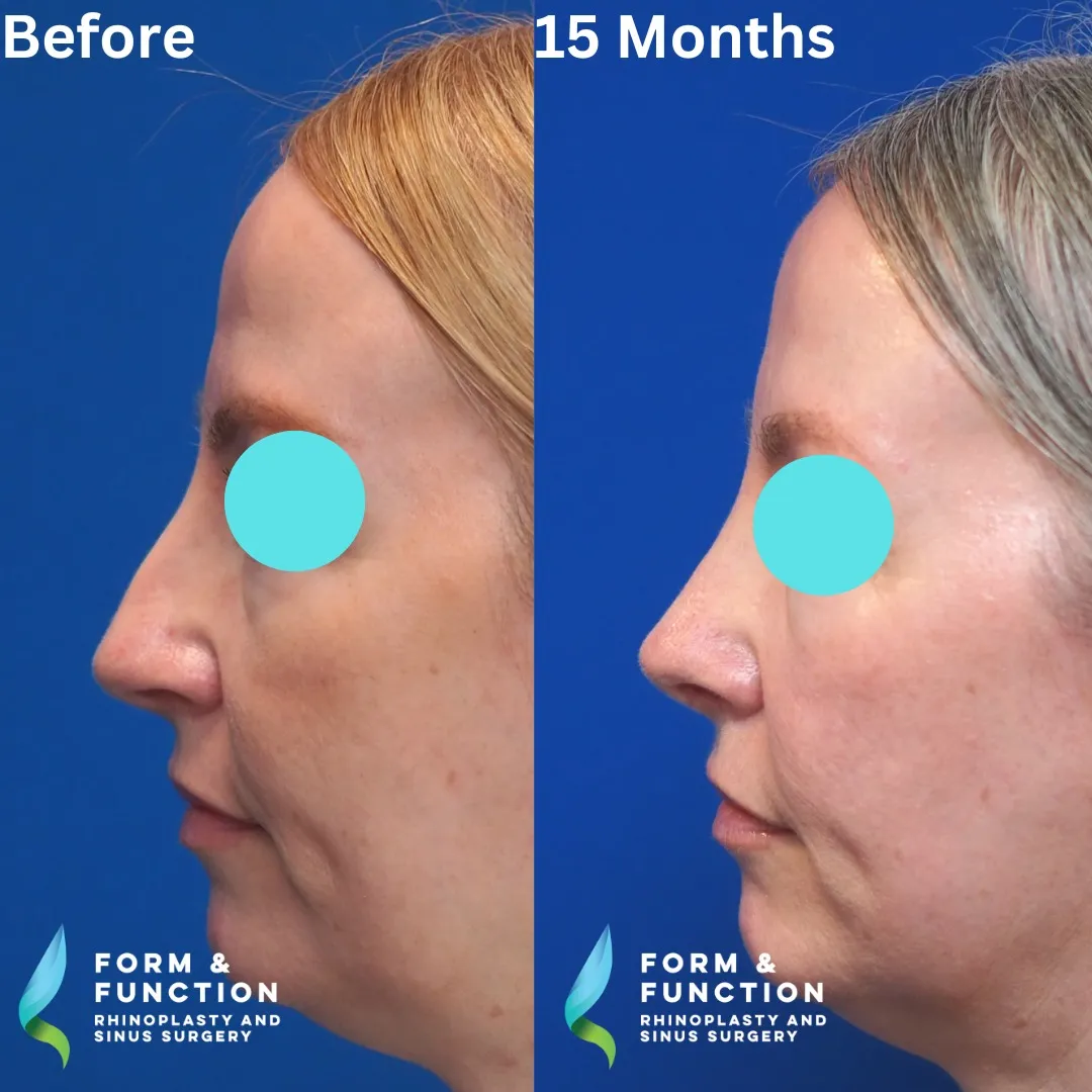 Before and after, left profile, 15 months after rhinoplasty and septoplasty