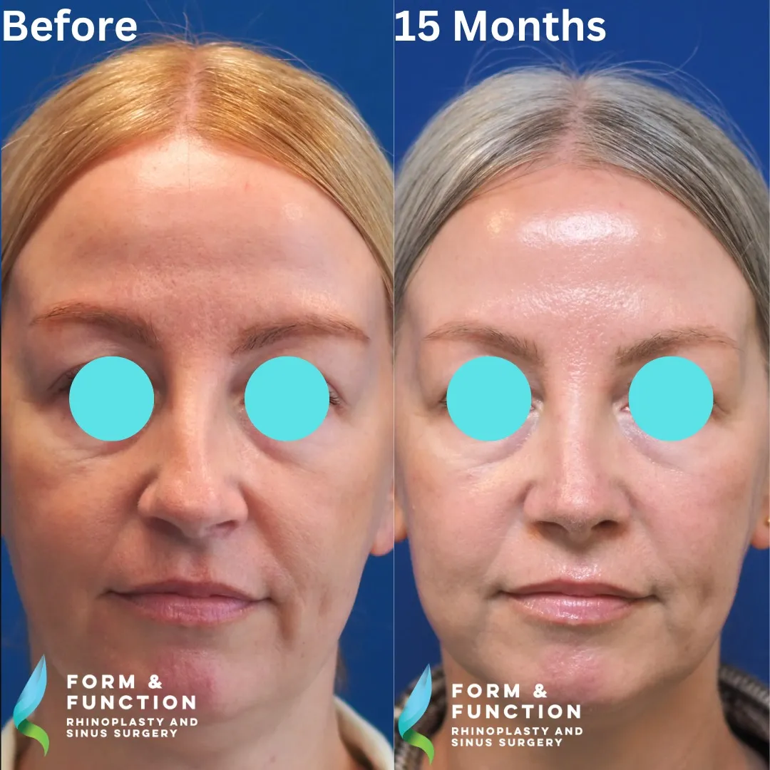 Before and after, 15 months after rhinoplasty and septoplasty (photograph 4 of 7)