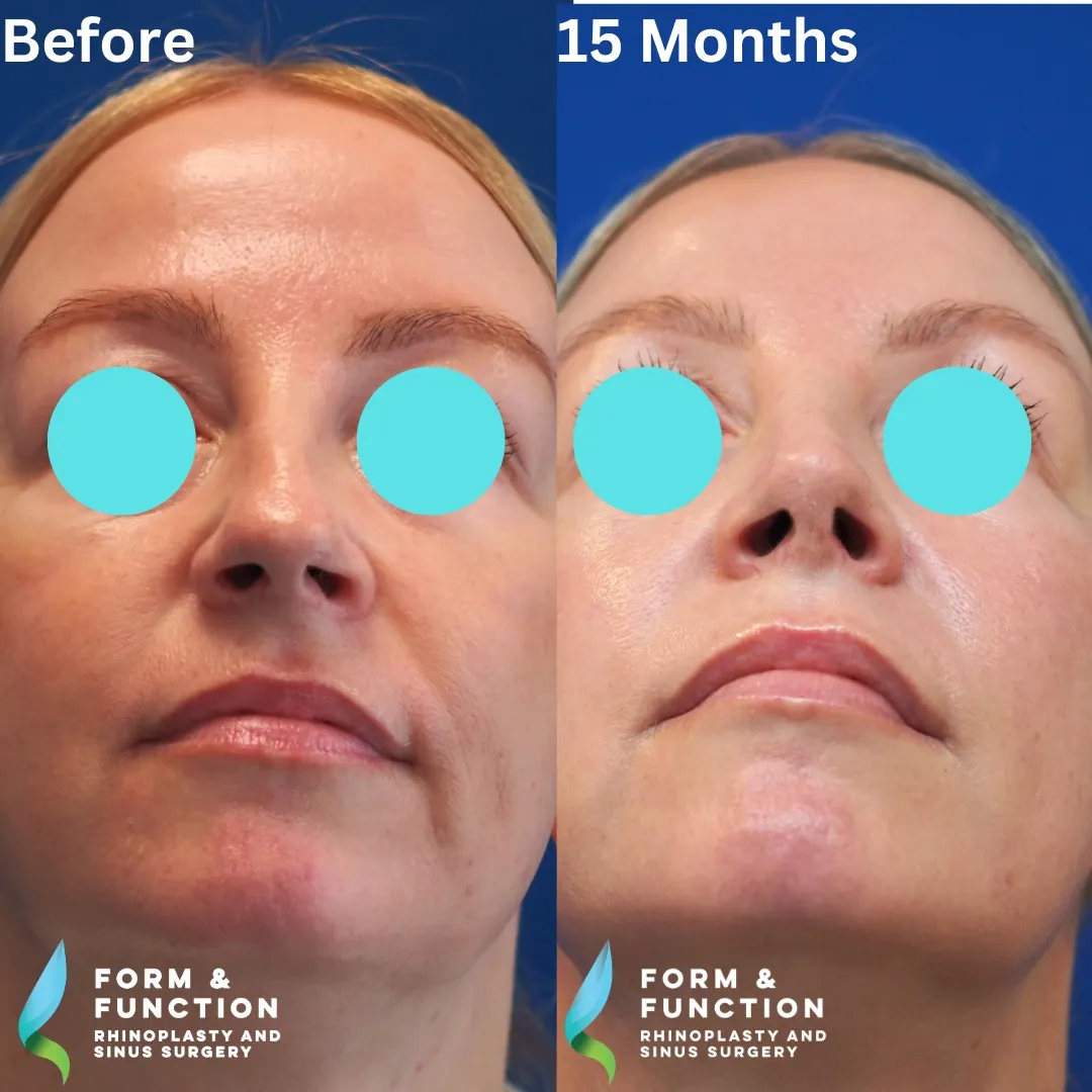 Before and after, base view, 15 months after rhinoplasty and septoplasty