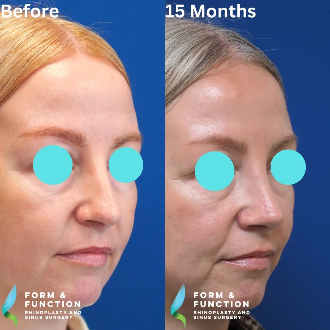 Before and after, 15 months after rhinoplasty and septoplasty (photograph 6 of 7)