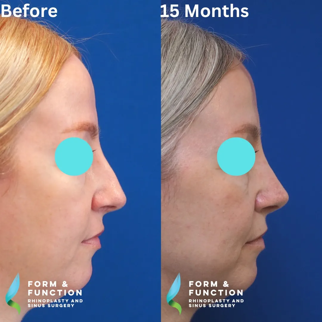 Before and after, right profile, 15 months after rhinoplasty and septoplasty