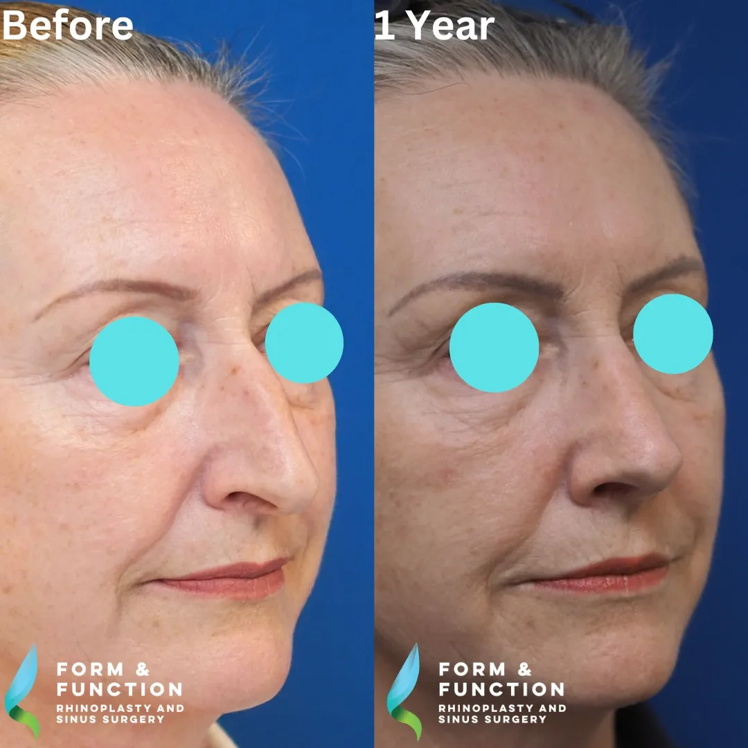 Before and after, left three-quarter view, 1 year after rhinoplasty and septoplasty
