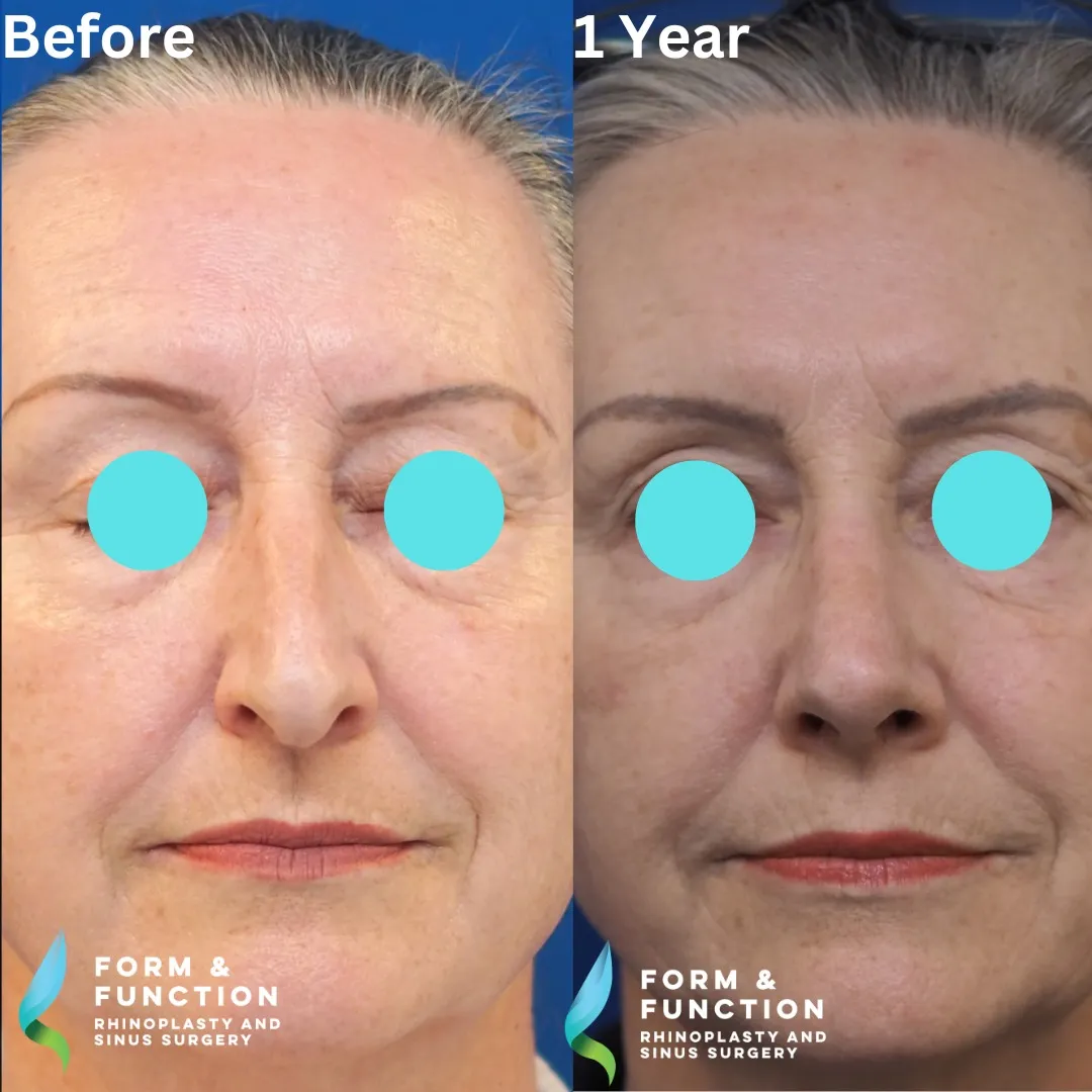 Before and after, frontal view, 1 year after rhinoplasty and septoplasty