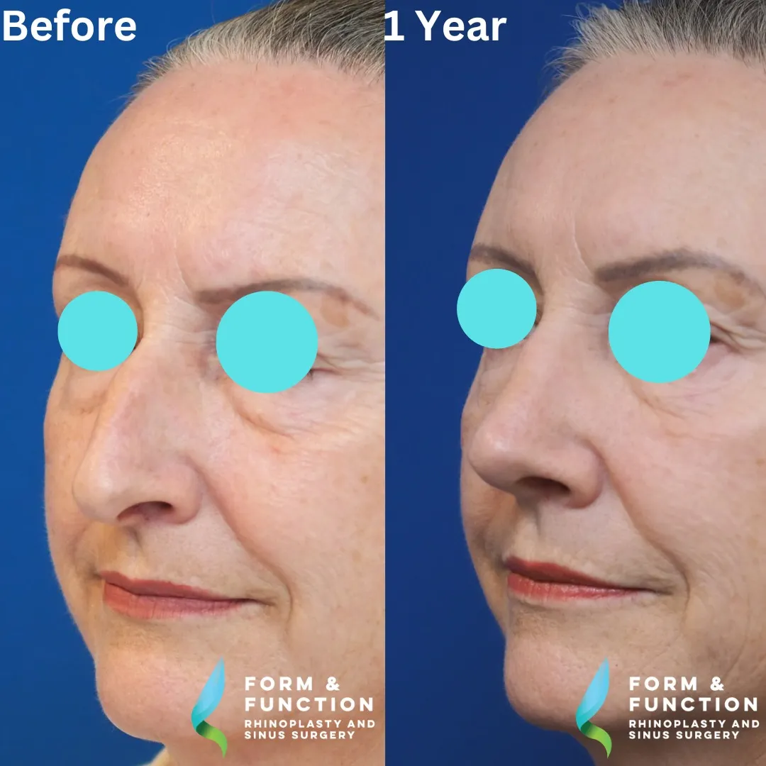 Before and after, 1 year after rhinoplasty and septoplasty (photograph 3 of 6)