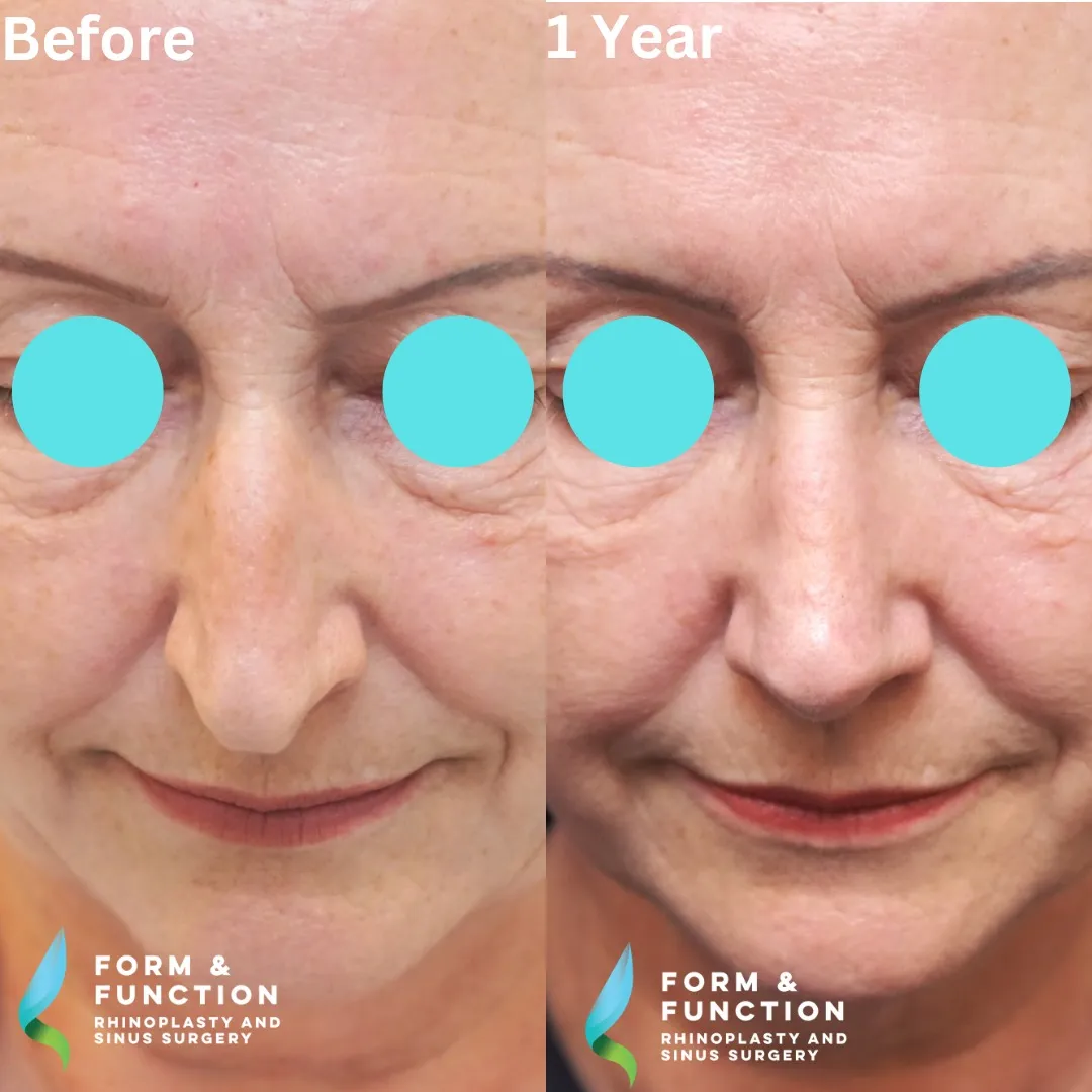 Before and after, 1 year after rhinoplasty and septoplasty (photograph 4 of 6)