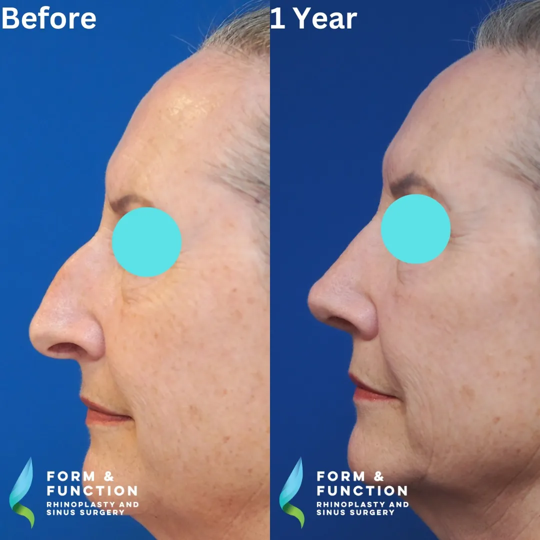 Before and after, right profile, 1 year after rhinoplasty and septoplasty