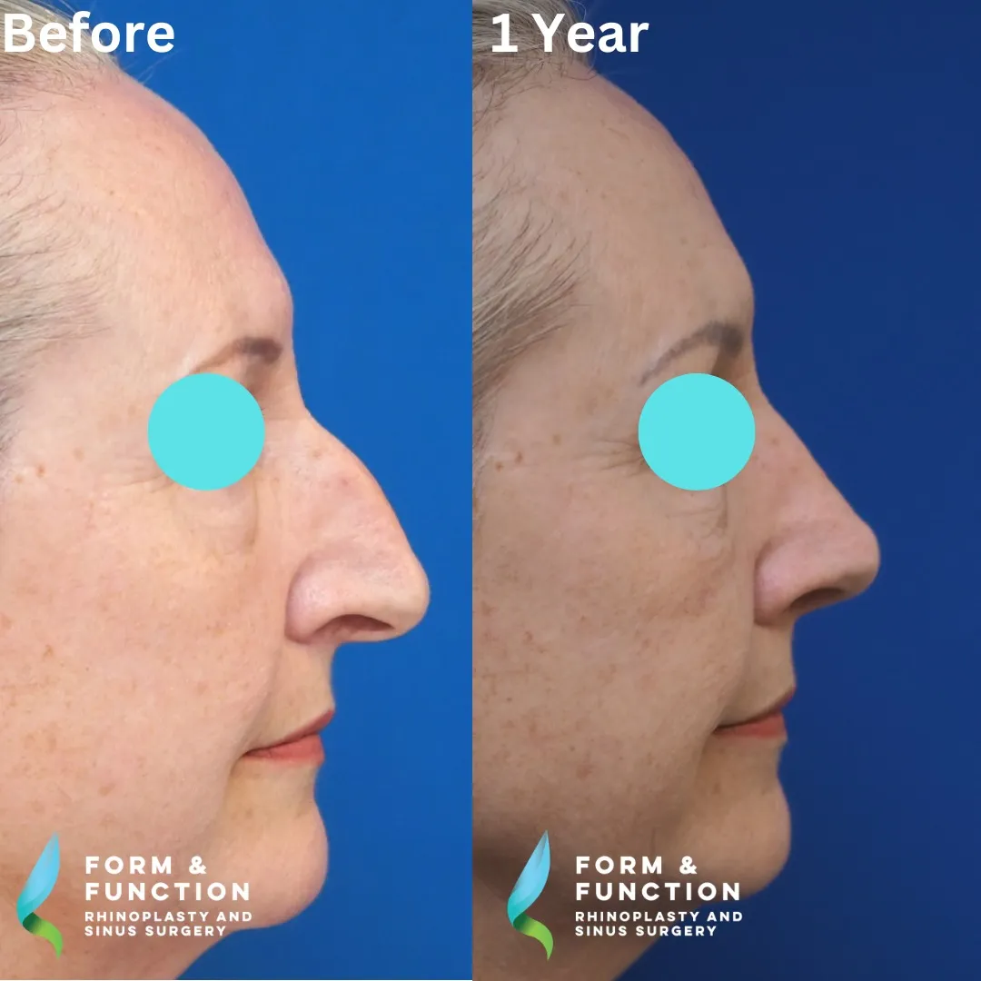 Before and after, 1 year after rhinoplasty and septoplasty (photograph 6 of 6)