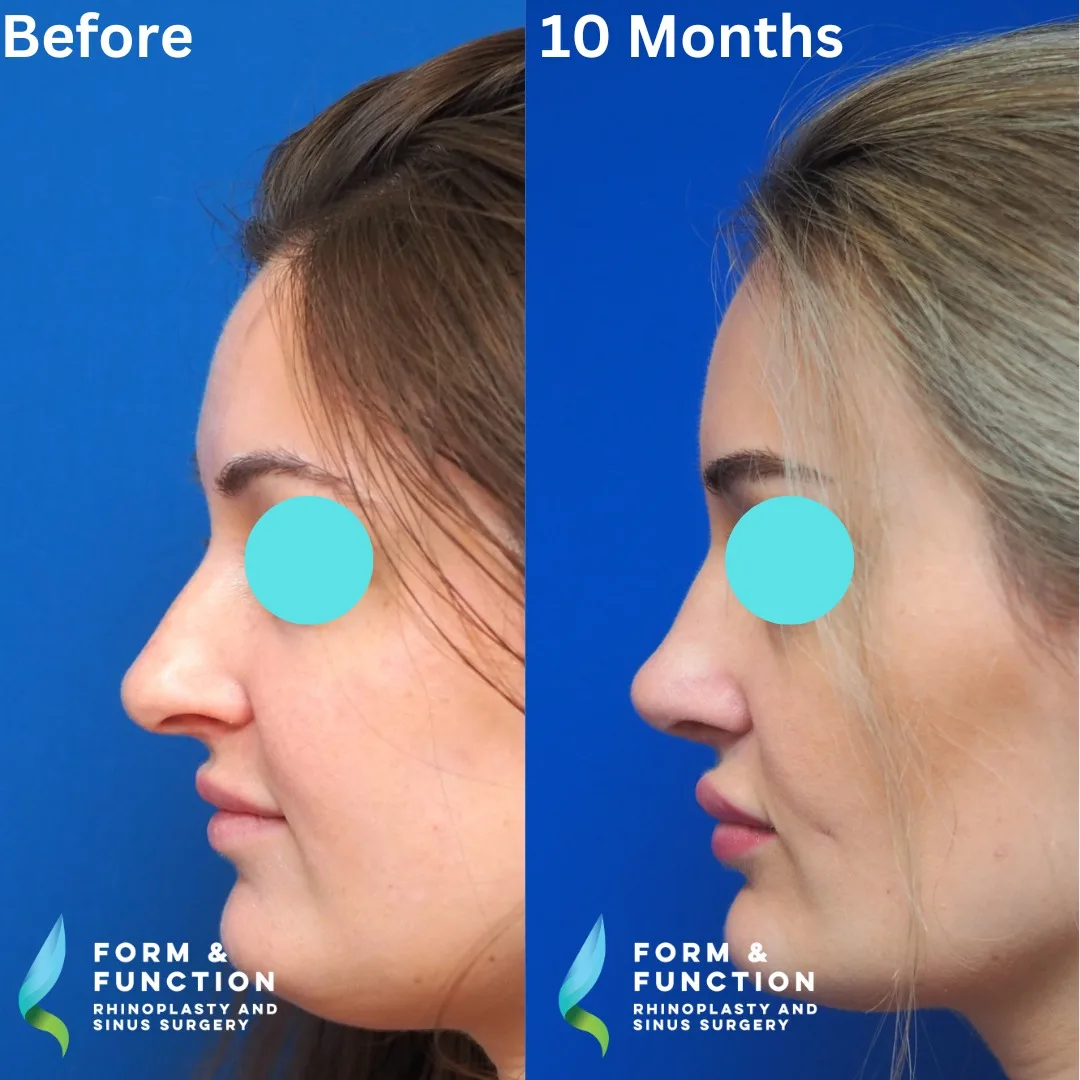 Before and after, left profile, 10 months after rhinoplasty and septoplasty