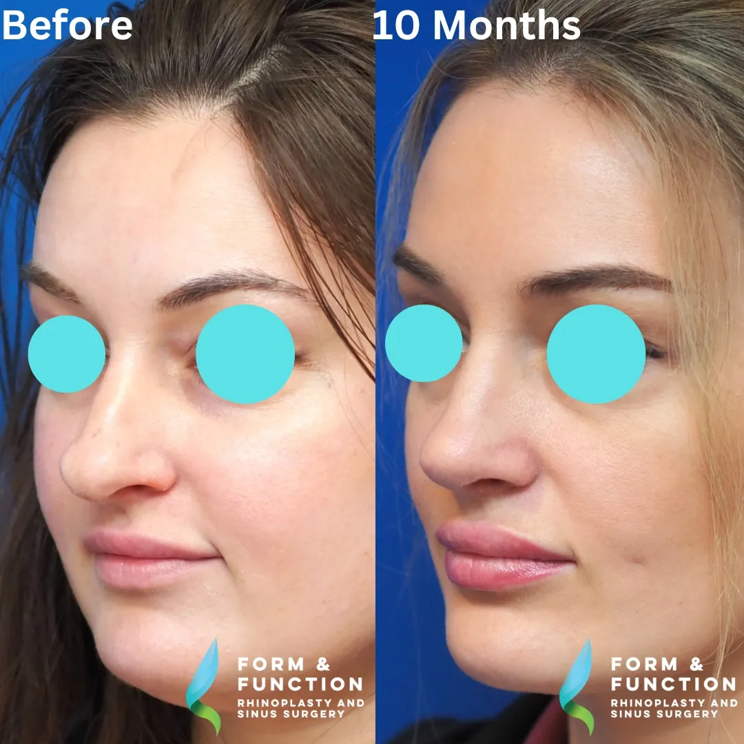 Before and after, left three-quarter view, 10 months after rhinoplasty and septoplasty