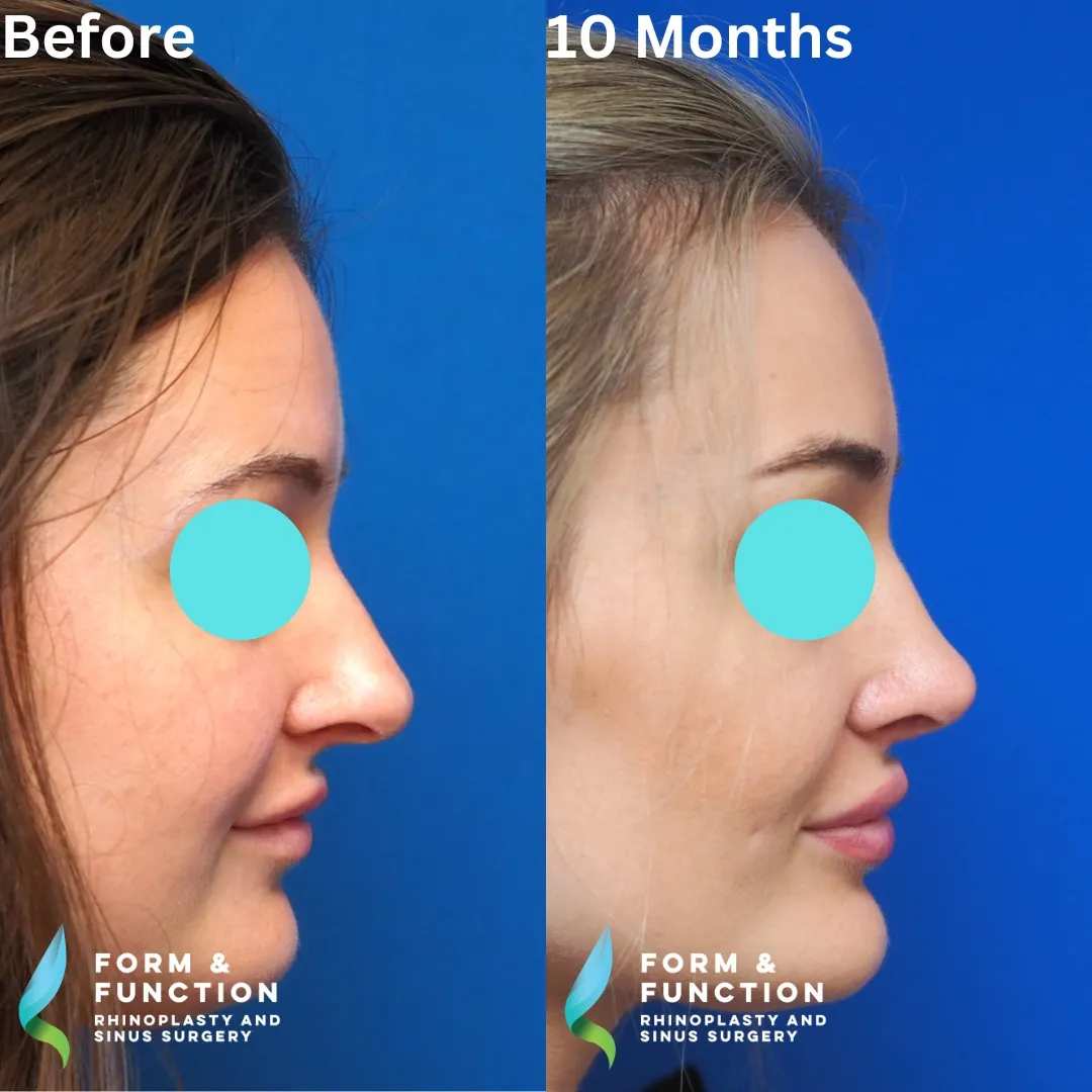Before and after, right profile, 10 months after rhinoplasty and septoplasty