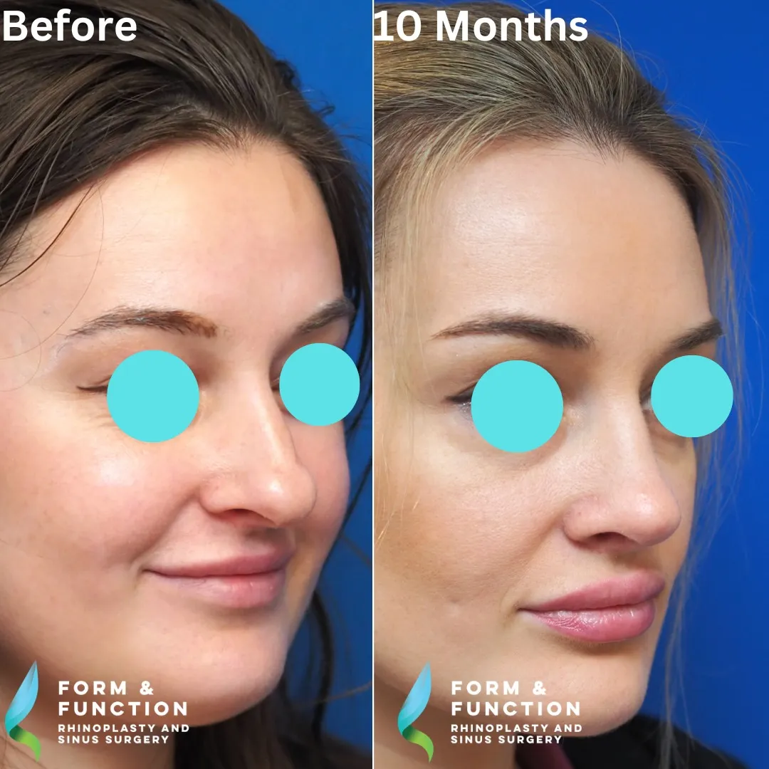 Before and after, 10 months after rhinoplasty and septoplasty (photograph 4 of 5)