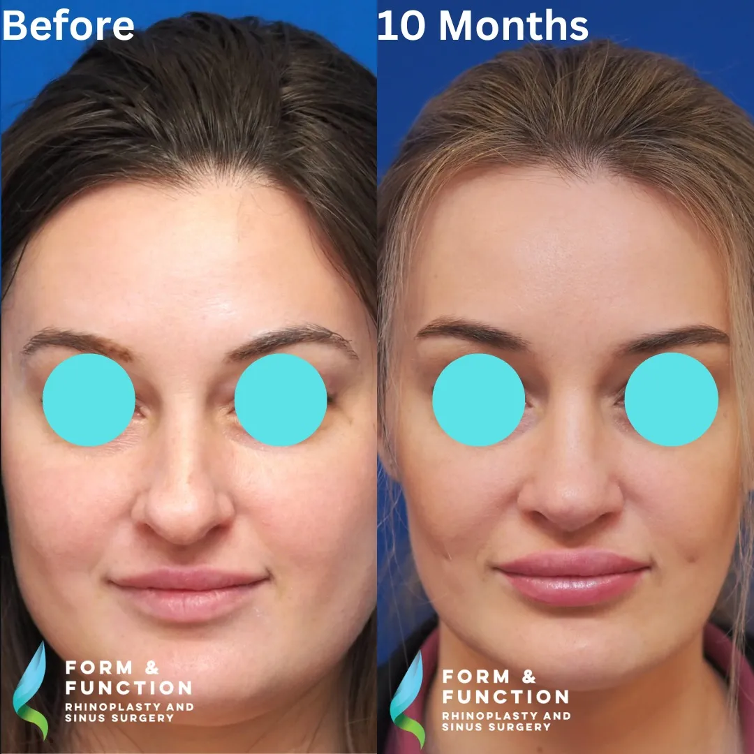 Before and after, frontal view, 10 months after rhinoplasty and septoplasty