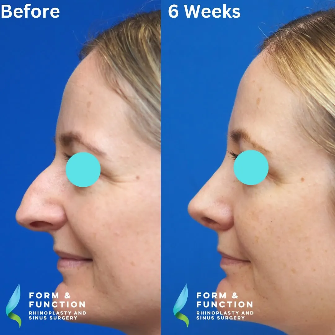 Before and after, left profile, 6 weeks after rhinoplasty and septoplasty