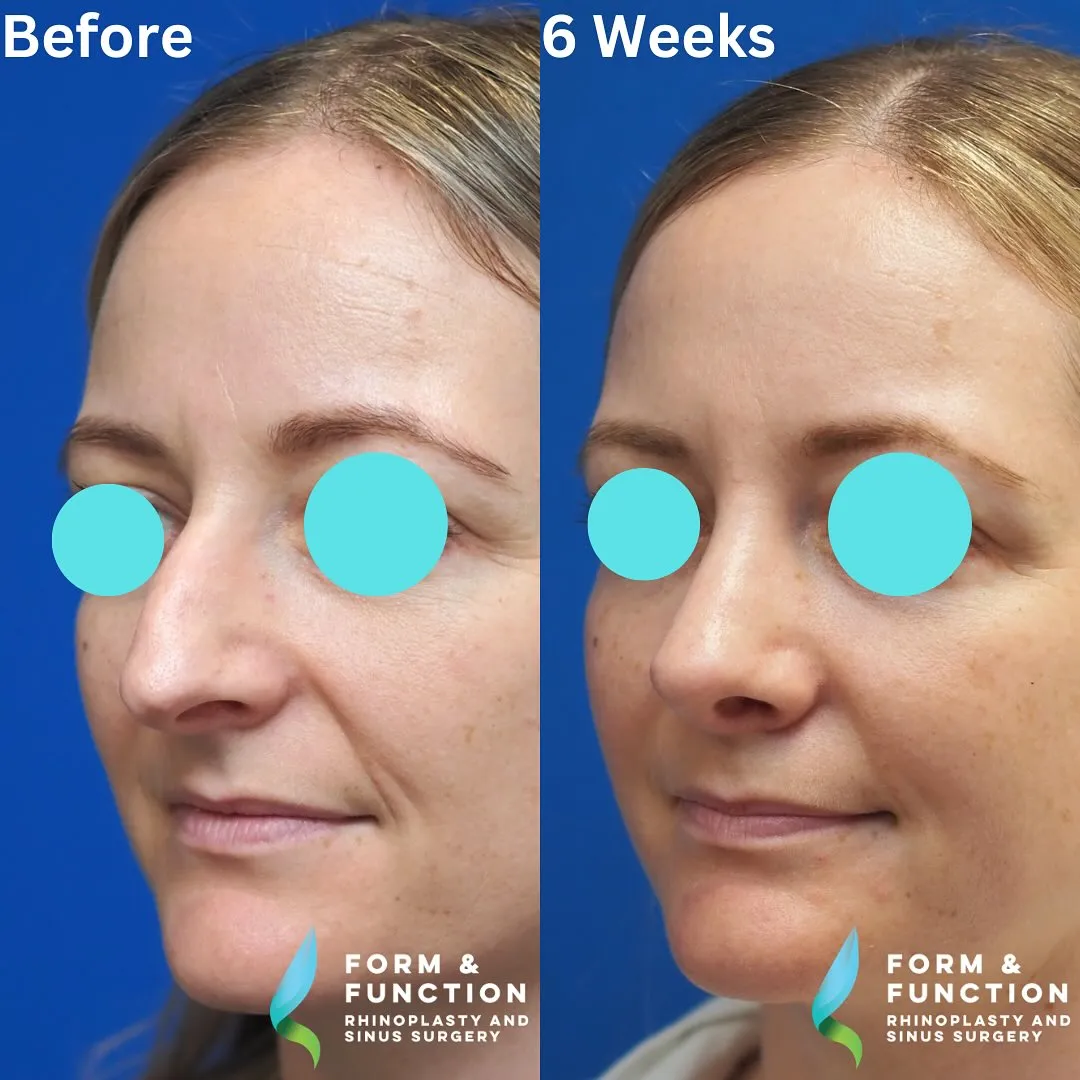 Before and after, left three-quarter view, 6 weeks after rhinoplasty and septoplasty