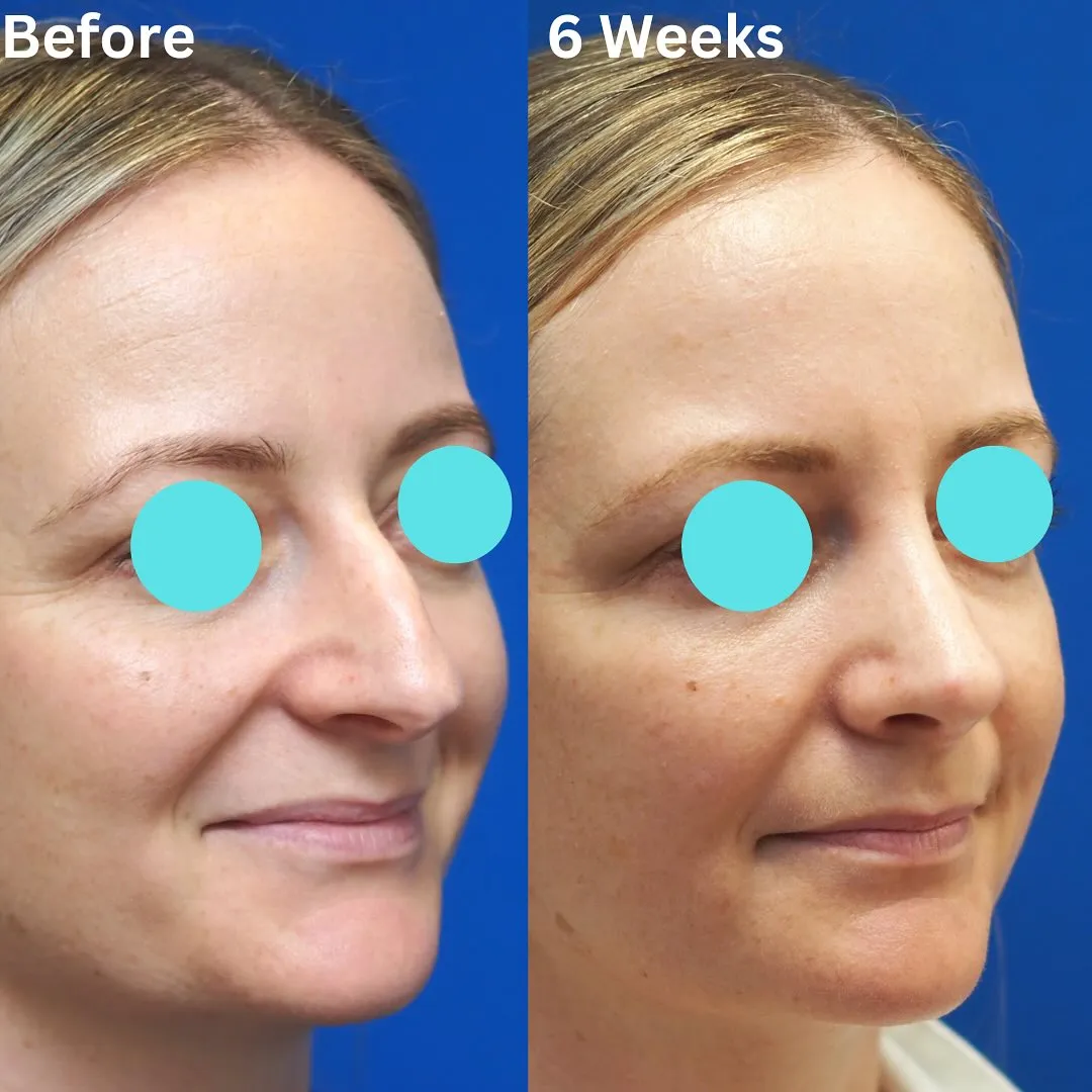 Before and after, right three-quarter view, 6 weeks after rhinoplasty and septoplasty