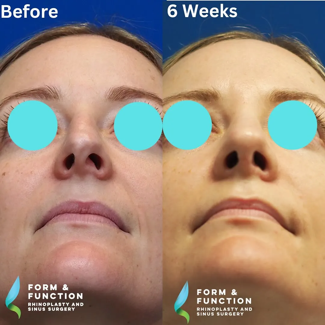 Before and after, base view, 6 weeks after rhinoplasty and septoplasty