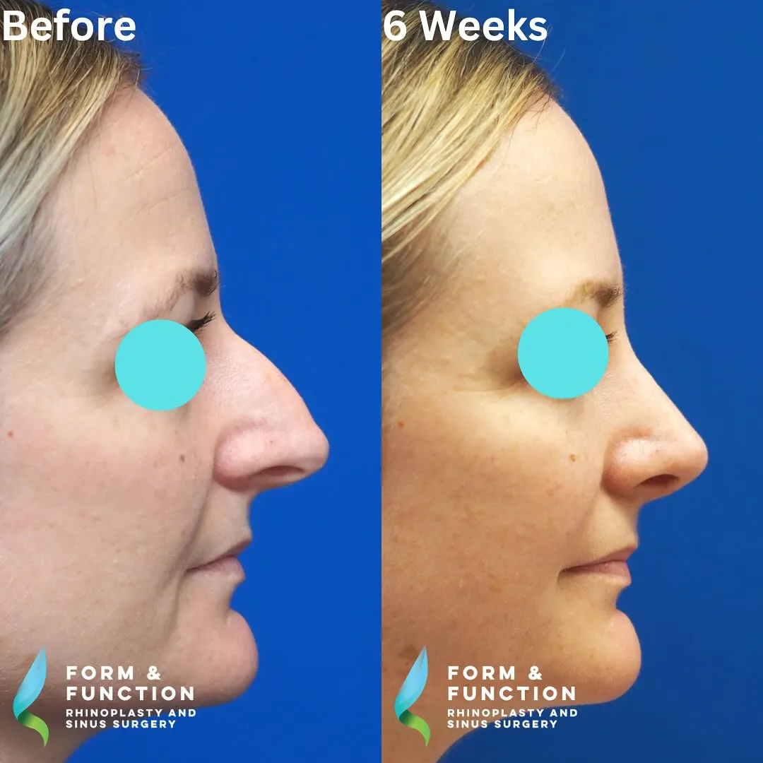 Before and after, right profile, 6 weeks after rhinoplasty and septoplasty