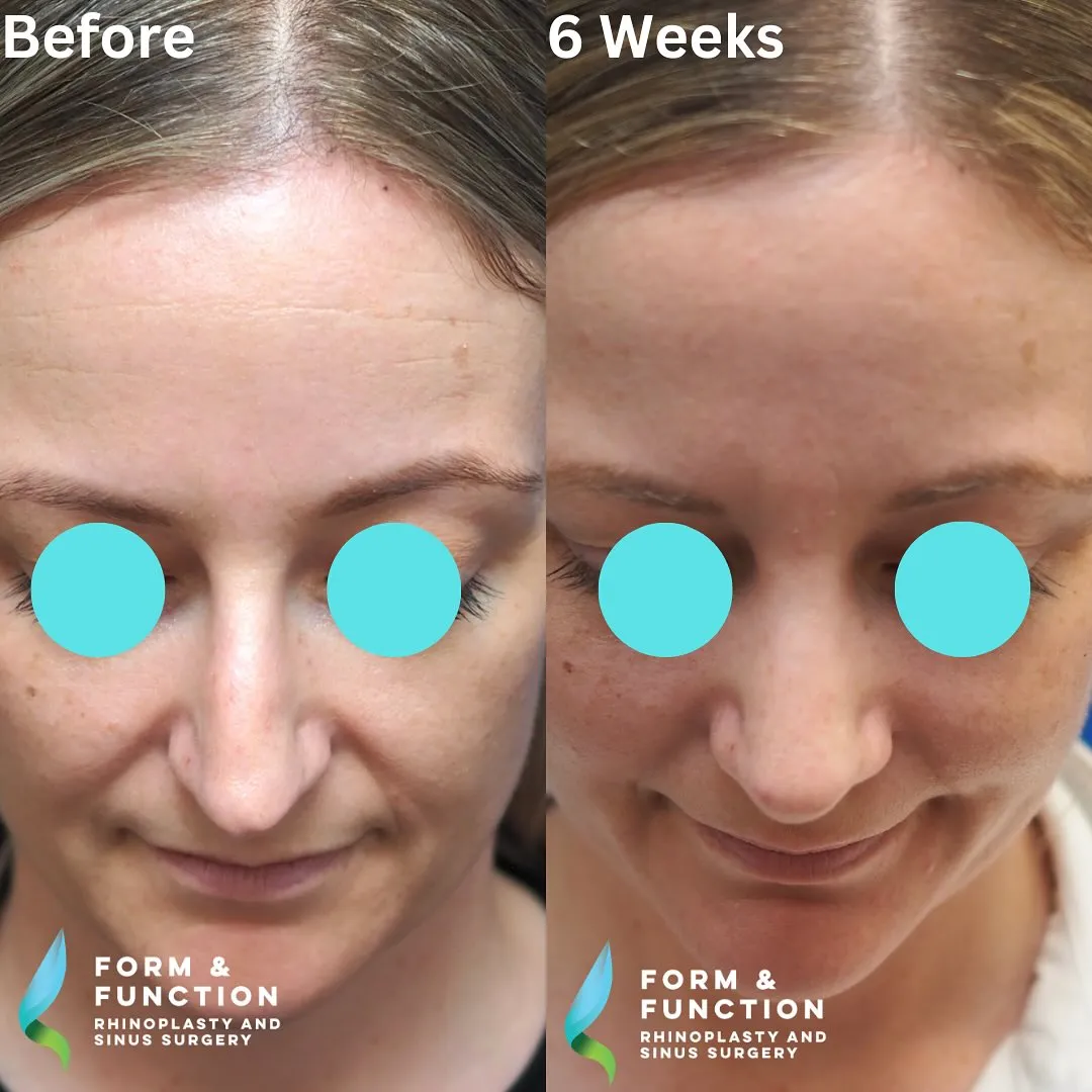 Before and after, 6 weeks after rhinoplasty and septoplasty (photograph 6 of 7)