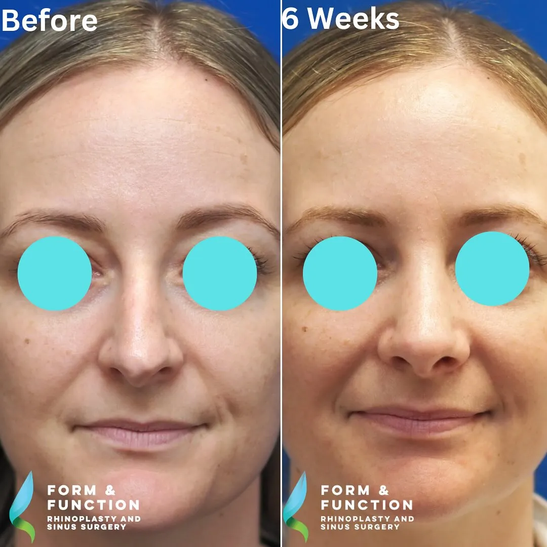 Before and after, frontal view, 6 weeks after rhinoplasty and septoplasty