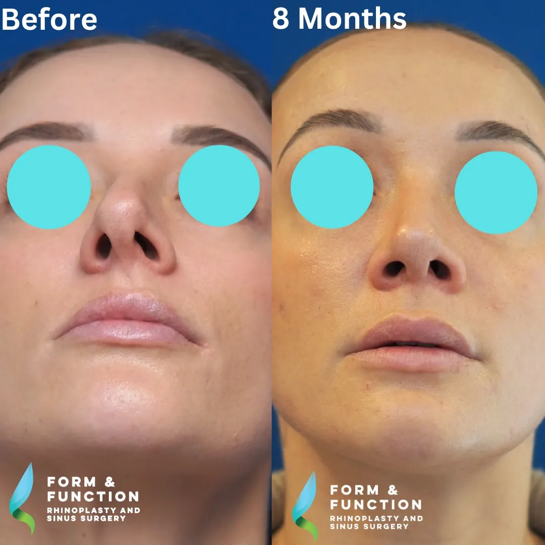 Before and after, base view, 8 months after rhinoplasty and septoplasty