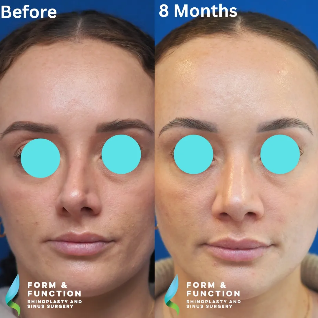 Before and after, frontal view, 8 months after rhinoplasty and septoplasty
