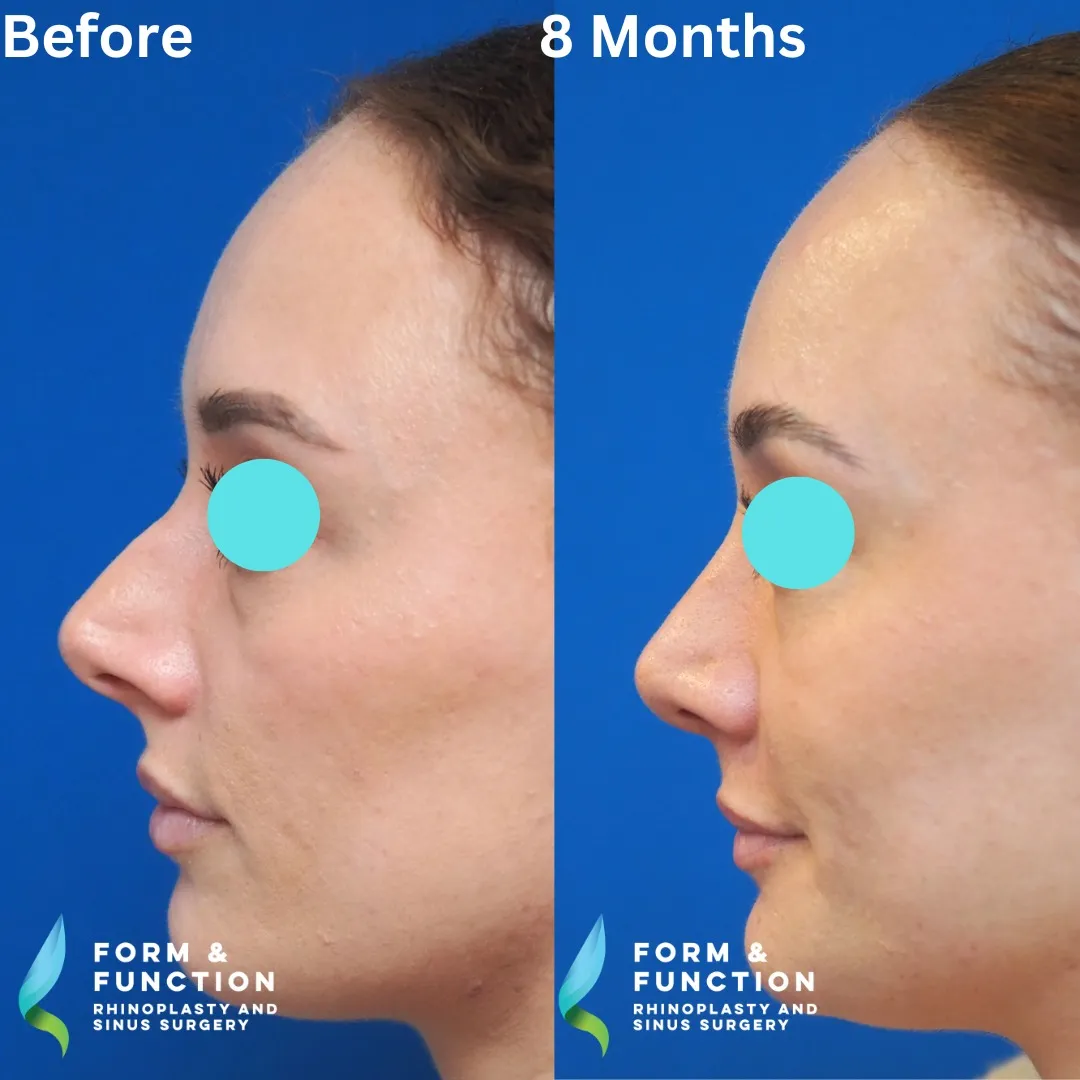 Before and after, left profile, 8 months after rhinoplasty and septoplasty