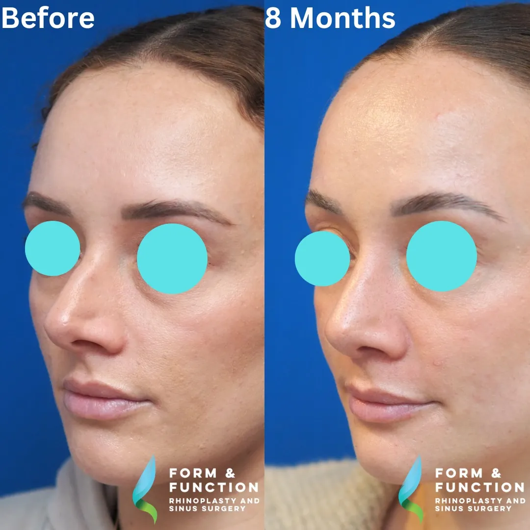 Before and after, left three-quarter view, 8 months after rhinoplasty and septoplasty