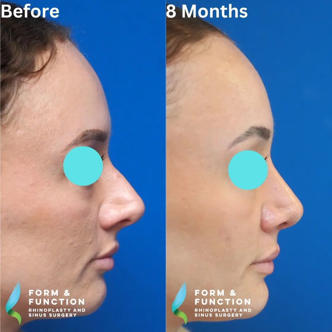 Before and after, right profile, 8 months after rhinoplasty and septoplasty