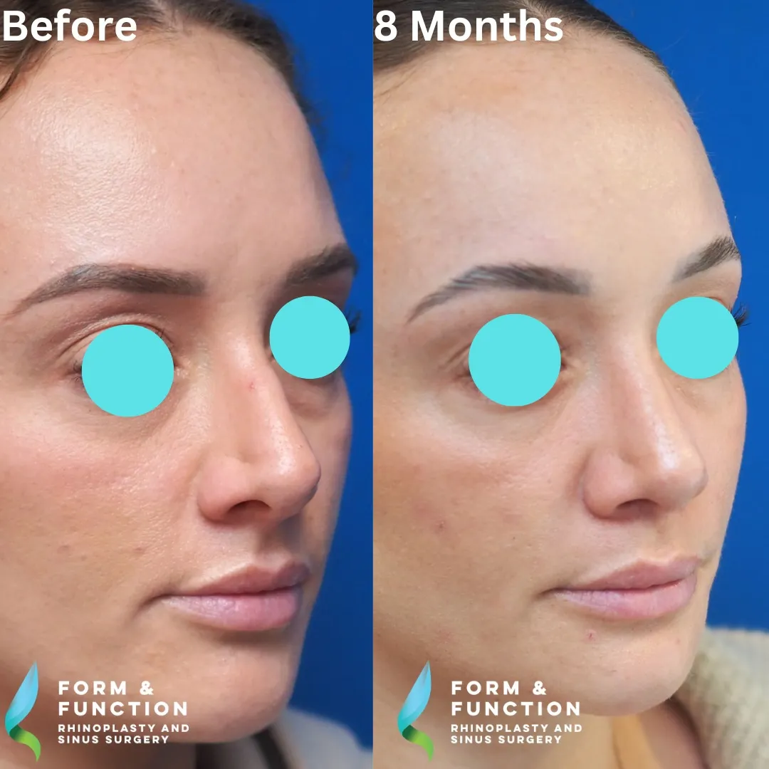 Before and after, 8 months after rhinoplasty and septoplasty (photograph 6 of 6)