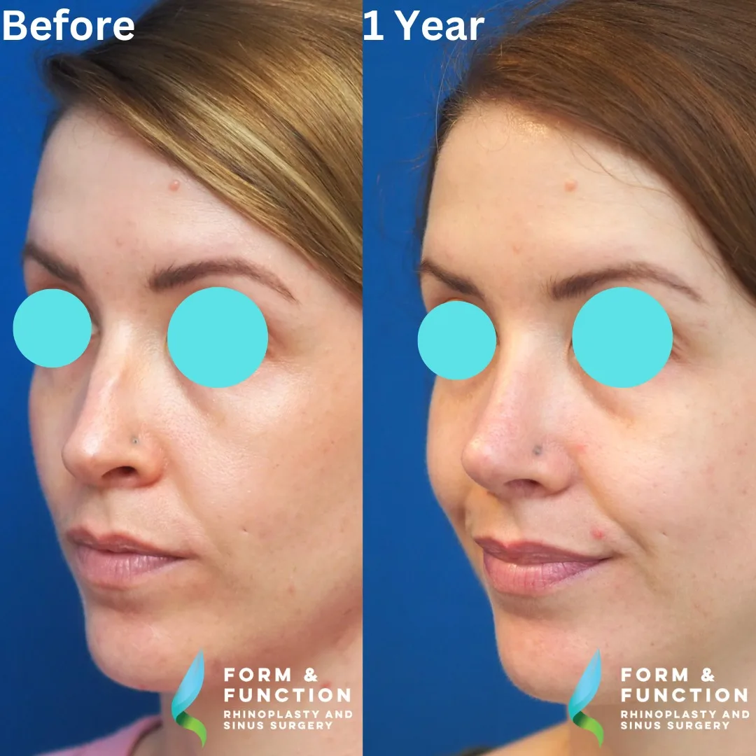 Before and after, left three-quarter view, 1 year after rhinoplasty and septoplasty