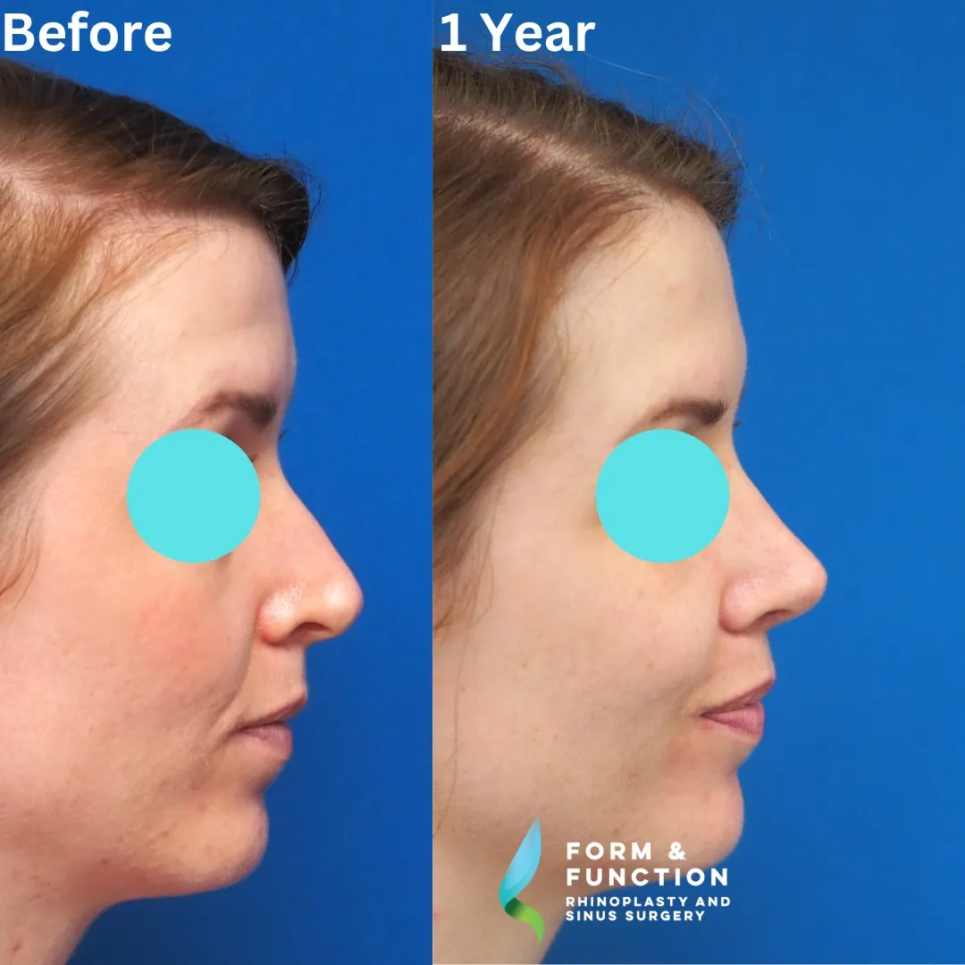 Before and after, right profile, 1 year after rhinoplasty and septoplasty