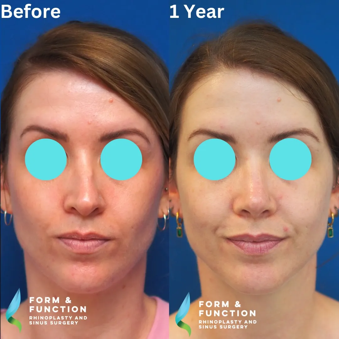 Before and after, frontal view, 1 year after rhinoplasty and septoplasty