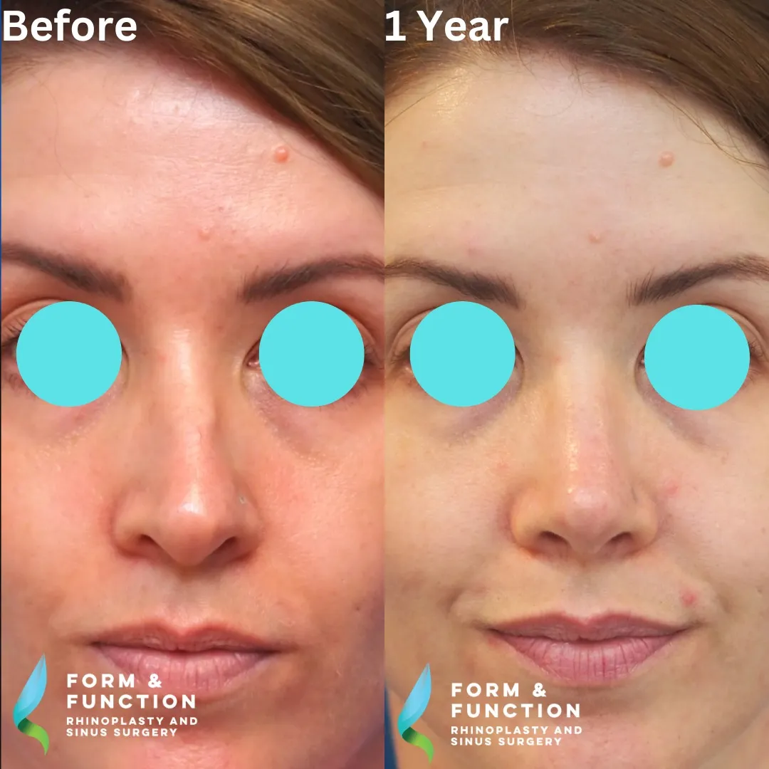 Before and after, base view, 1 year after rhinoplasty and septoplasty