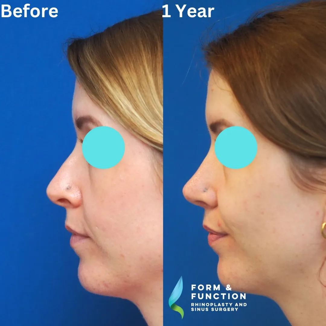 Before and after, left profile, 1 year after rhinoplasty and septoplasty