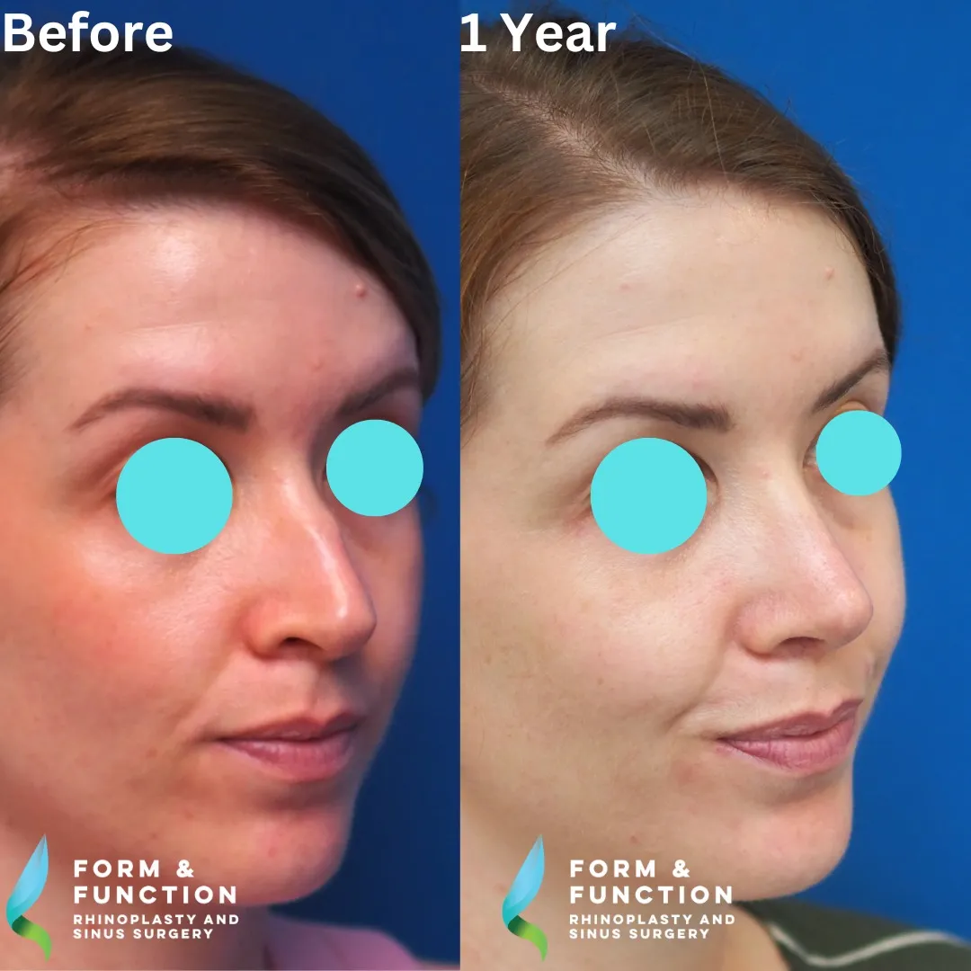 Before and after, 1 year after rhinoplasty and septoplasty (photograph 6 of 8)