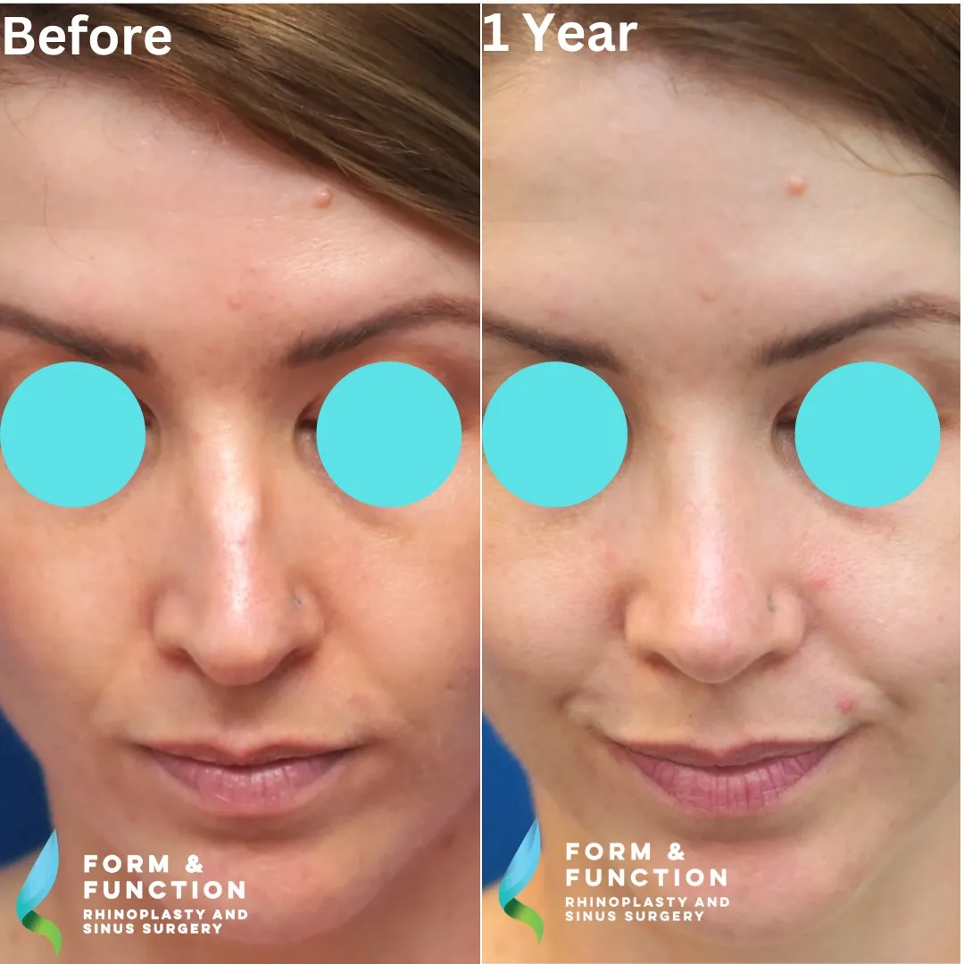 Before and after, 1 year after rhinoplasty and septoplasty (photograph 7 of 8)