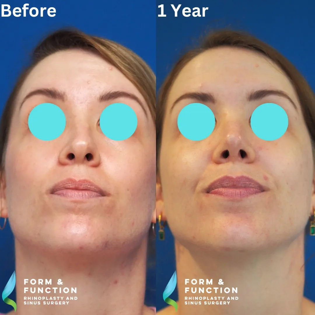 Before and after, 1 year after rhinoplasty and septoplasty (photograph 8 of 8)