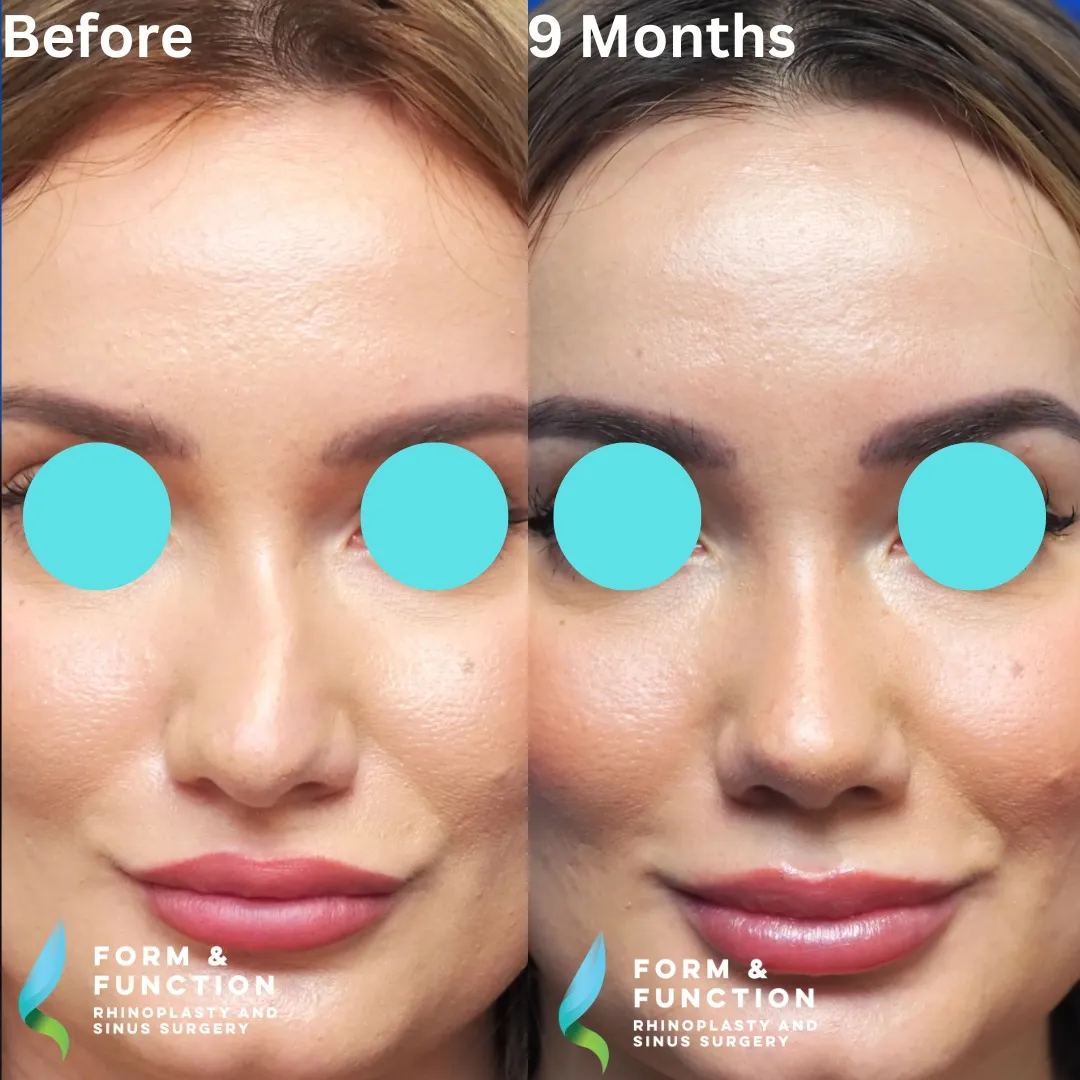 Before and after, frontal view, 9 months after rhinoplasty and septoplasty