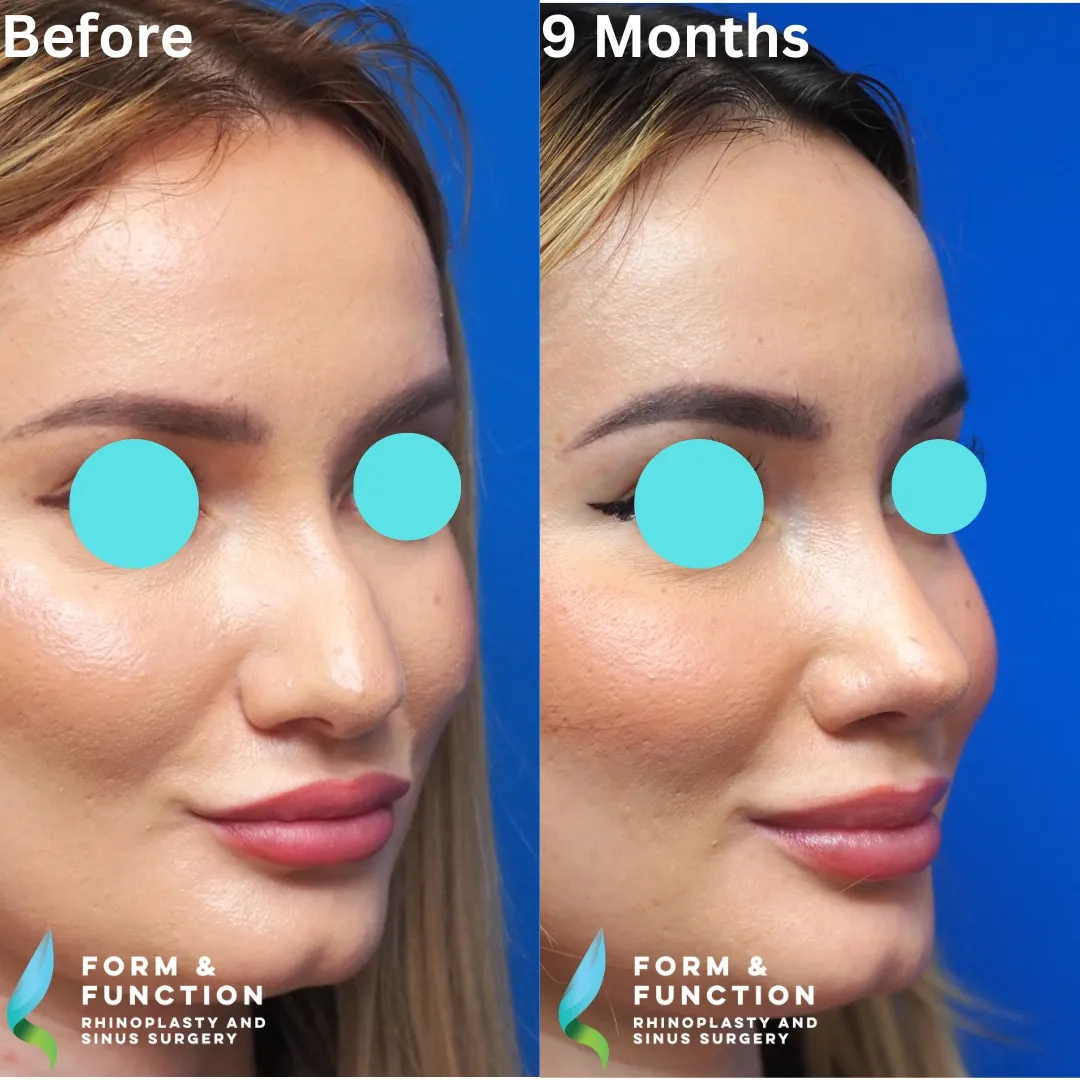 Before and after, right three-quarter view, 9 months after rhinoplasty and septoplasty