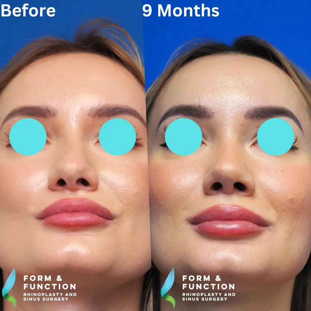 Before and after, 9 months after rhinoplasty and septoplasty (photograph 3 of 7)