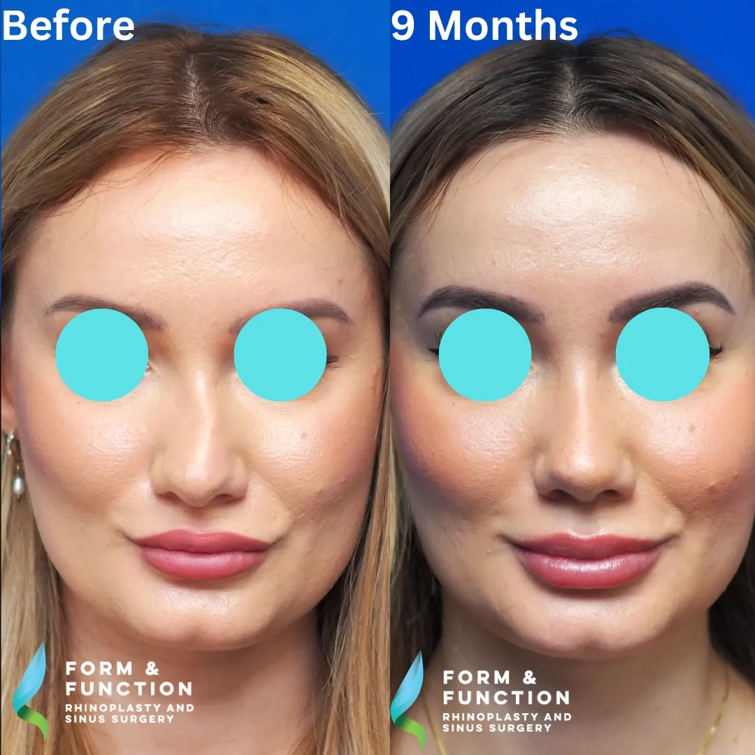 Before and after, 9 months after rhinoplasty and septoplasty (photograph 4 of 7)